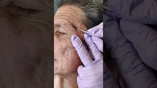 Acne extraction of blackheads and whiteheads popping pimples in Los Angeles [upl. by Ennasor466]