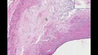 Histopathology Coronary arteriesAtherosclerosis [upl. by Reehsab]