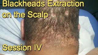 Blackheads Extraction on the Scalp  Session IV [upl. by Fagen]