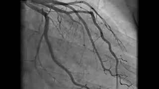 Coronary Angiography  NEJM [upl. by Odrude]