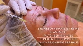 Mesotherapie mit Hyaluronsäure  Behandlung Vorher Nachher [upl. by Ecirtaed]