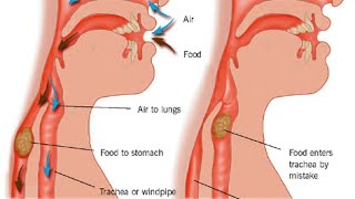 Aspiration Pneumonia [upl. by Dajma124]