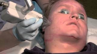 Fraxel Laser Subcision Acne Scar Treatment [upl. by Rimahs994]