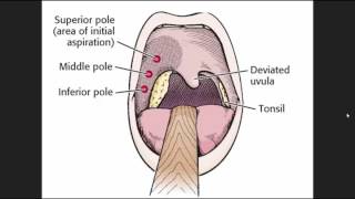 Morning ReportEmergency Medicine Peritonsillar Abscess [upl. by Arbmahs]