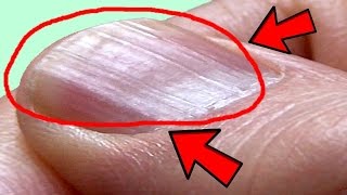 What Causes Ridges in Finger and Toenails [upl. by Gena]