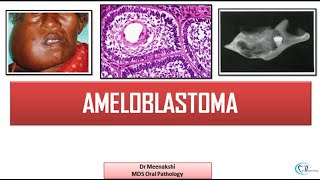 Ameloblastoma  Benign Odontogenic Tumor [upl. by Ynehpets712]