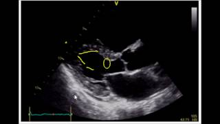 Estimating Ejection Fraction with Point of Care Echo [upl. by Thane362]