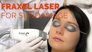 Fraxel Fractional laser resurfacing [upl. by Yrahcaz997]