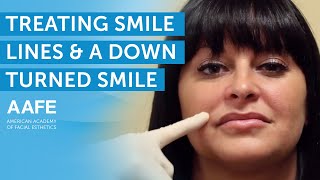 Treating Smile Lines and a Downturned Smile  AAFE [upl. by Naro]