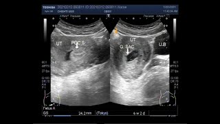 Ultrasound Video showing Incomplete abortion [upl. by Aba]