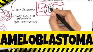 Ameloblastoma  Origination Clinical Radiographic amp Histopathologic features [upl. by Ecirehs570]