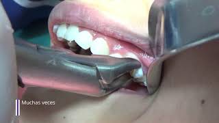 Extracción dental en niñosExtracción de dientes temporales [upl. by Jerrome]