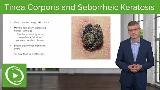 Tinea Corporis Ring Worm and Seborrheic Keratosis – Dermatology  Lecturio [upl. by Concha]