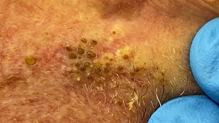 Extremely Clogged Pores Extracted  Contour Dermatology [upl. by Atiuqrehs193]