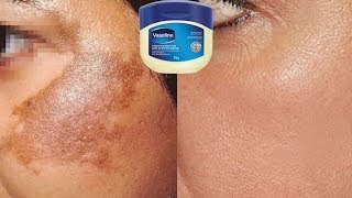 How To Use Vaseline To Remove Skin Pigmentation In Just 10 Days  Home Remedies [upl. by English425]