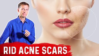 Best Way to Rid Acne Scars [upl. by Eikceb]