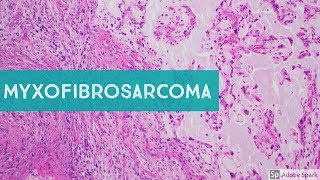 Myxofibrosarcoma 101Explained by a Sarcoma Pathologist [upl. by Atirrehs756]