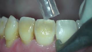 Biofilm stains and young calculus removal from teeth [upl. by Trubow]