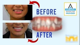 Invisalign Before and After Crowded Teeth [upl. by Anyad463]