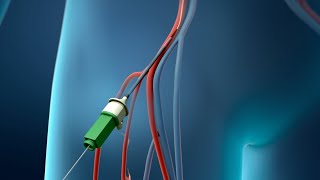 Coronary Angioplasty Femoral Access [upl. by Nicolau]