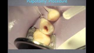 Pulp Therapy and Primary Tooth Pulpotomy  Video Review [upl. by Olegnad]