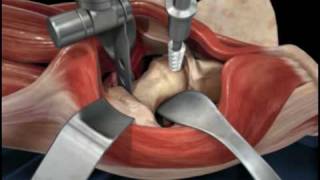 Direct Anterior Approach Hip Replacement [upl. by Dadinirt323]