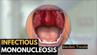 Infectious mononucleosis Causes Signs and Symptoms Diagnosis and Treatment [upl. by Tildy]