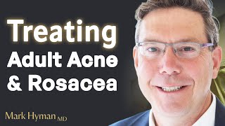 Treating Adult Acne amp Rosacea From The Inside Out [upl. by Ylhsa]