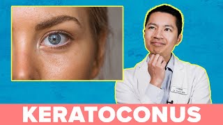 Will I Go Blind If I Have Keratoconus [upl. by Aerda]