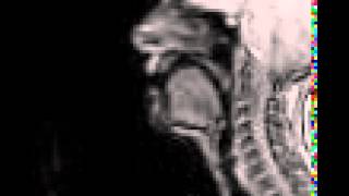 Voiced uvular trill MRI [upl. by Ario]