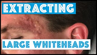 Acne Vulgaris and Extracting large Whiteheads  Part 1 [upl. by Kenzi664]