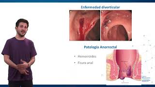 Hemorragia digestiva baja [upl. by Asa]