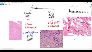 Systemic pathology 76  Liver tumors Dr Sameh Ghazy [upl. by Skiest]