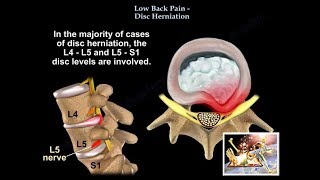 Inguinal Hernia Anatomy 12  Direct and Indirect Inguinal Hernia  Abdomen  Anatomy [upl. by Naig]