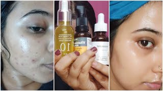 Best Affordable Vitamin C Serums to Remove Pimple marks dark spots Minimalist Recast Its Skin [upl. by Honebein785]