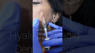 Hyaluronic filler injections for acne scars [upl. by Niai]