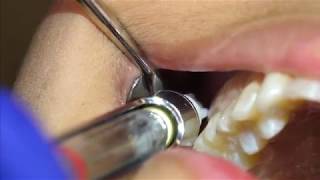 Posterior Superior Alveolar PSA Injection Demonstration and Overview 4K [upl. by Aniratac]