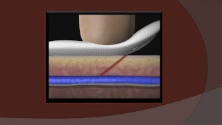 Postvenipuncture Pressure How much How long [upl. by Eveline]