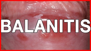 Balanitis Symptoms Causes Treatment and Prevention [upl. by Joshi400]