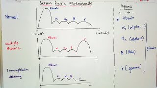 Serum Protein Electrophoresis importance and result interpretation in an easy way [upl. by Aihtekal]