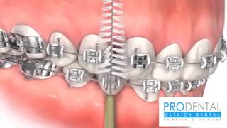 ¿Cómo lavarse correctamente los dientes con brackets [upl. by Hutchinson]