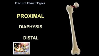 Fracture Femur Types  Everything You Need To Know  Dr Nabil Ebraheim [upl. by Kalman]