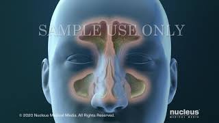 Sinusitis Surgery [upl. by Renaldo]