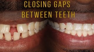 Closing Gaps Between Teeth With Braces [upl. by Komsa]