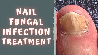 HOW TO TREAT FUNGAL NAIL INFECTION  TINEA UNGUIUM  ONYCHOMYCOSIS [upl. by Valorie132]