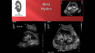 Fetal Unilateral Hydronephrosis  Ultrasound  Anomaly  Case 44 [upl. by Alor833]