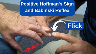 Positive Hoffmans Sign and Babinski Reflex in an MS Patient [upl. by Inek]