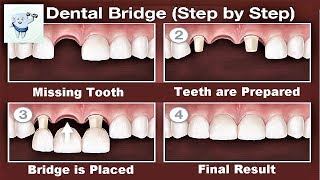 Dental Bridge Procedure Step by Step [upl. by Assert]