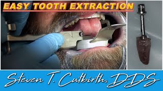 Easy Tooth Extraction  Dental Minute with Steven T Cutbirth DDS [upl. by Georgine]