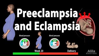 Advanced Obs amp Gyne Lecture THE MANAGEMENT OF SEVERE PRE ECLAMPSIA amp ECLAMPSIA Part 1 [upl. by Ardnalak588]